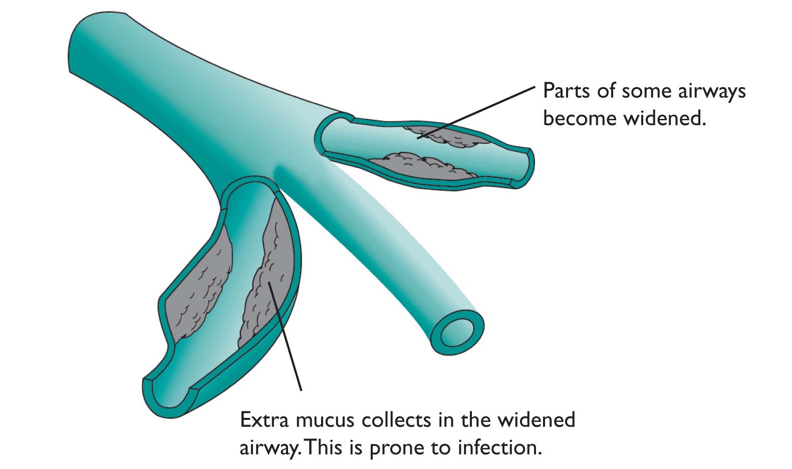 Bronchiectasis - Chest Heart &amp; Stroke Scotland