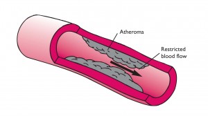 Atheroma build up in a coronary artery causing a restricted blood flow