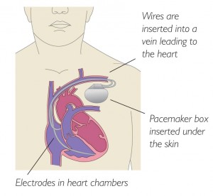 A pacemaker is an electrical device that is used to correct and regulate an abnormal heart rhythm.