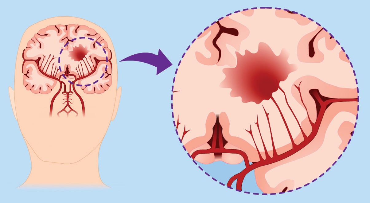 Cara Penyembuhan Stroke Serangan Kedua