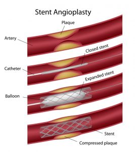 stent angioplasty