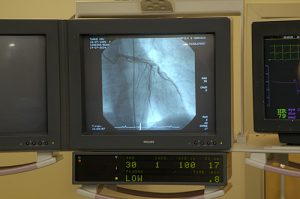 An angiogram is performed to assess damage to your coronary arteries